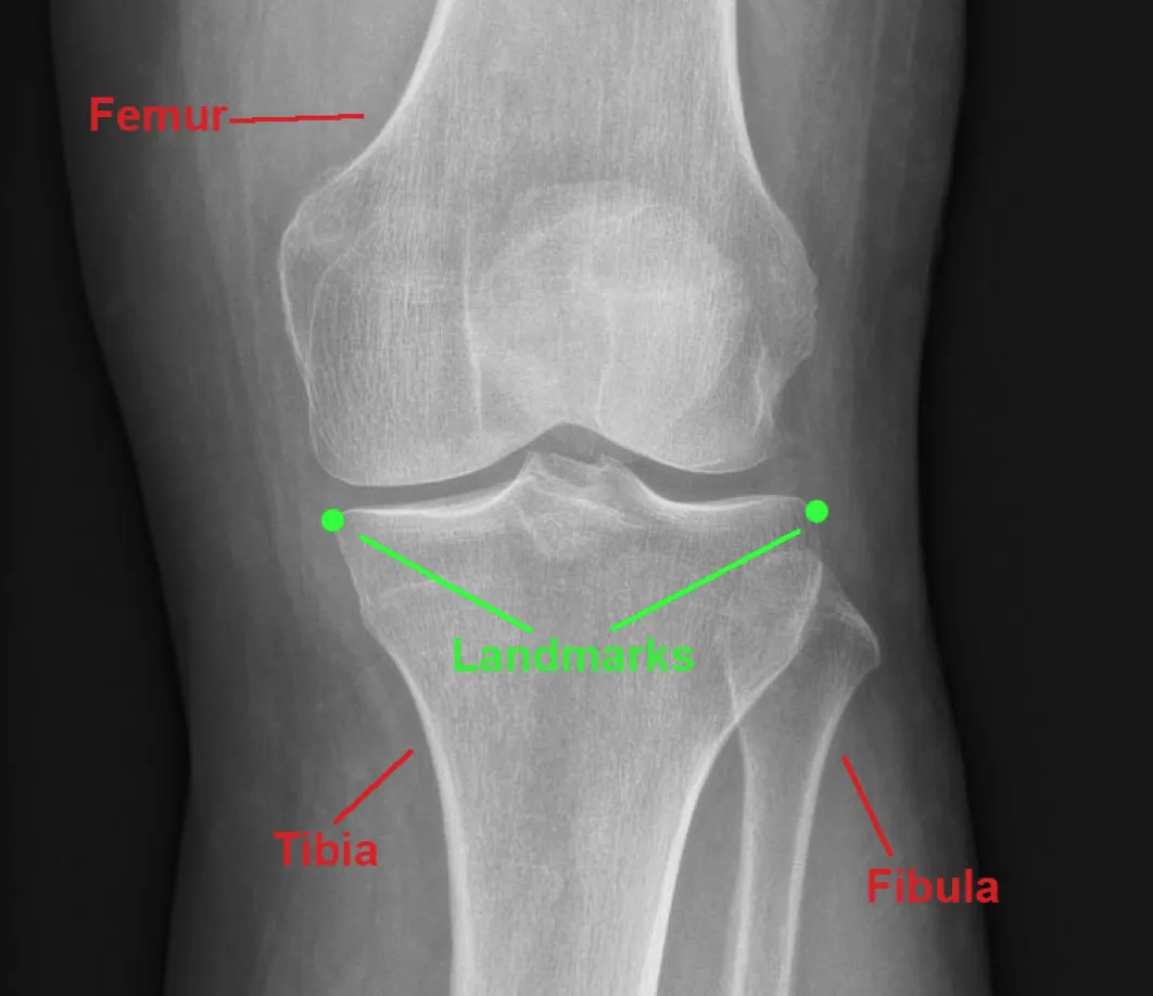 Bachelor’s Thesis: Osteoarthritis Visualization