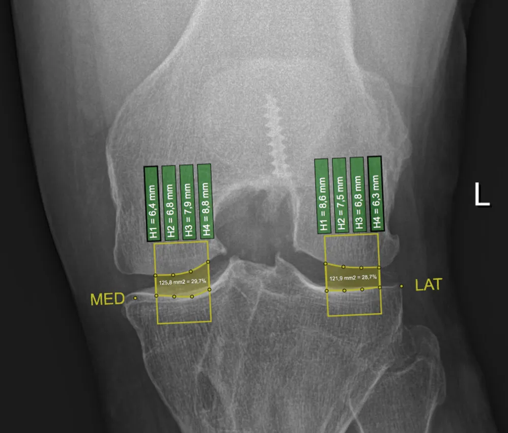 Bachelor’s Thesis: Osteoarthritis Visualization screenshot 2