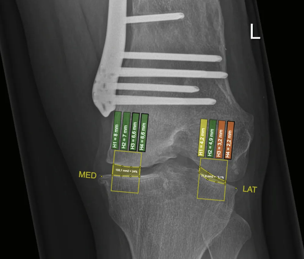 Bachelor’s Thesis: Osteoarthritis Visualization screenshot 3