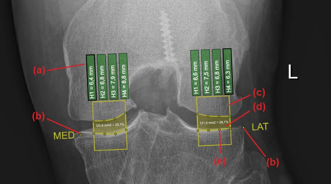 Bachelor’s Thesis: Osteoarthritis Visualization screenshot 4